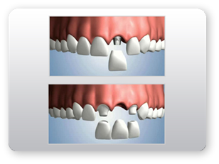 Lucrare Dentara pe implant