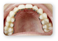 Aparat Dentar Lingual Invizibil